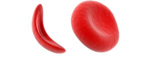 Combating Sickle Cell Disease with Cord Blood Stem Cells 